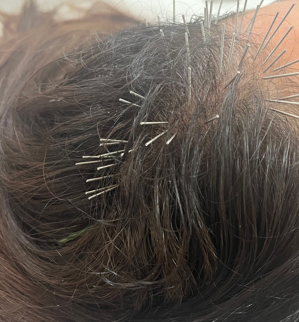 מחטי דיקור דקות בקרקפת בין שערות הראש