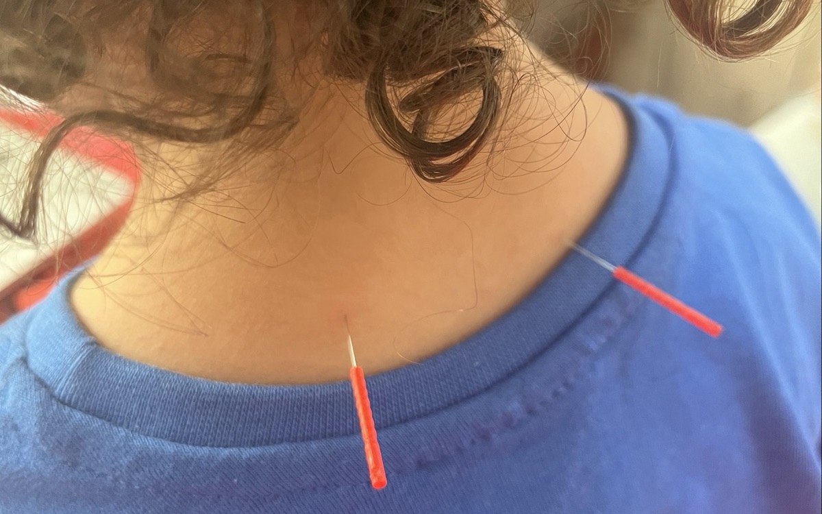 ילד בחולצה כחולה עם מחטי דיקור זעירות בעורף, בזמן טיפול רגוע